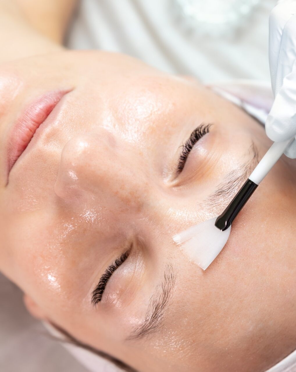 Close-up of a chemical peel treatment on a young woman.