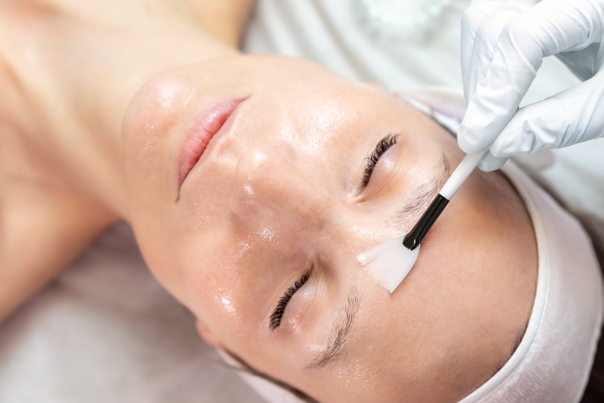 Close-up of a chemical peel treatment on a young woman.
