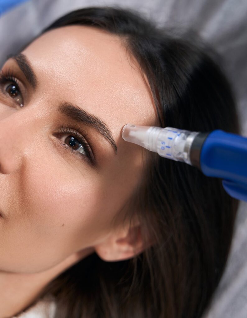 Beautiful young woman receiving a microneedling treatment.