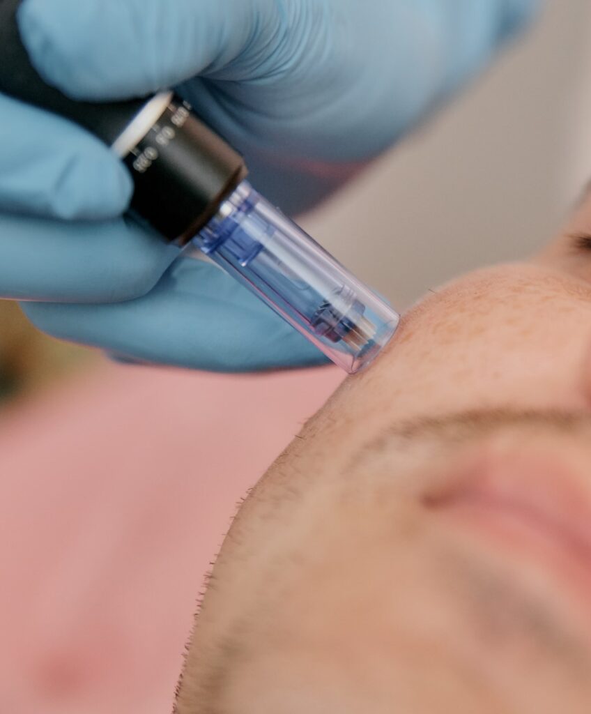 Microneedling on the face of a young man close-up